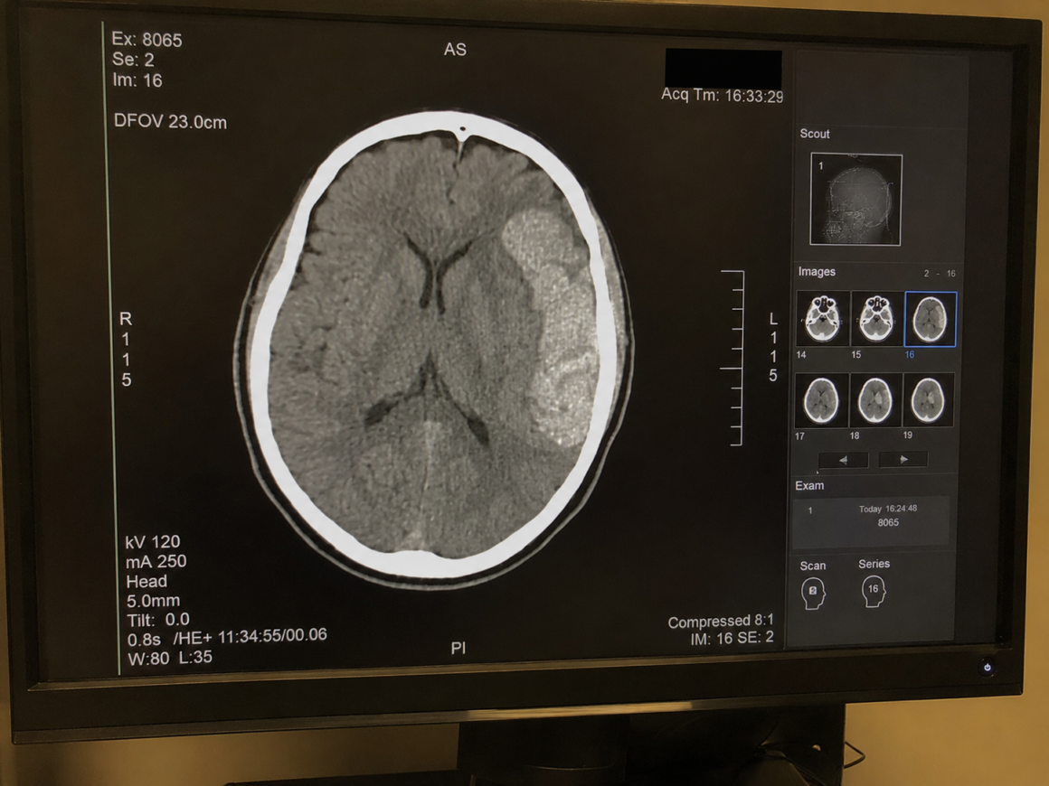 brain injury scan